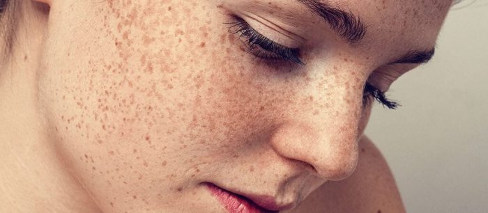از بین بردن جای لک با ماسک خانگی